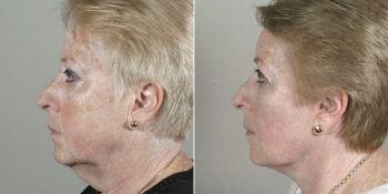 Face Lift Patient 25