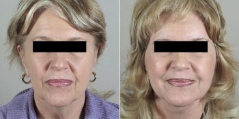 Face Lift Patient 26
