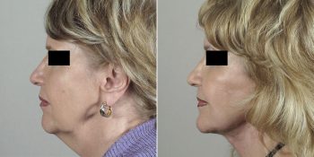 Face Lift Patient 26