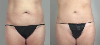 Brazilian Butt Lift Patient 3