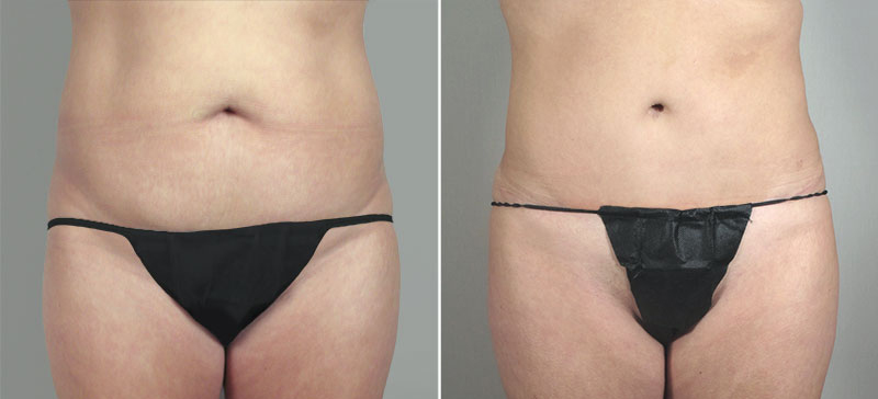 Brazilian Butt Lift Patient 3