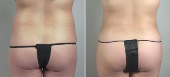 Brazilian Butt Lift Patient 3