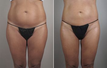 Brazilian Butt Lift Patient 2