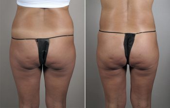 Brazilian Butt Lift Patient 2