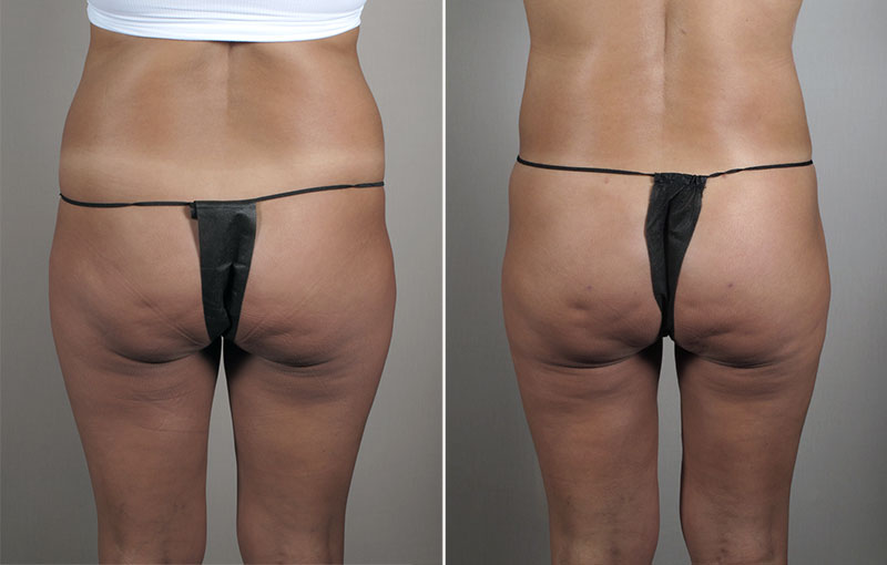 Brazilian Butt Lift Patient 2