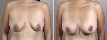 Breast Enlargement (Augmentation) Patient 59