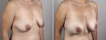 Breast Enlargement (Augmentation) Patient 59