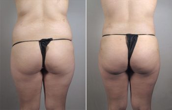 Breast Enlargement (Augmentation) Patient 59