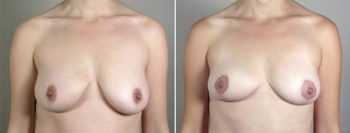 Breast Lift with Auto-Augmentation Patient 2