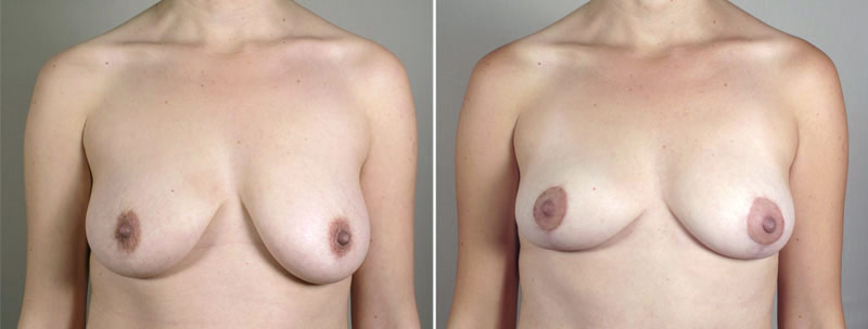 Breast Lift with Auto-Augmentation Patient 2