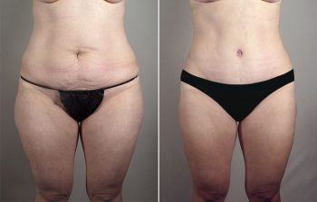 Breast Lift with Auto-Augmentation Patient 2