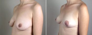 Breast Lift with Auto-Augmentation Patient 2