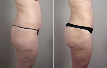 Breast Lift with Auto-Augmentation Patient 2