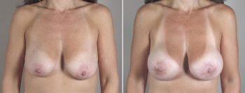 Breast Lift with Implants Patient 24