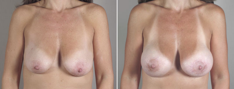 Breast Lift with Implants Patient 24