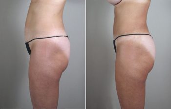 Breast Lift with Implants Patient 24