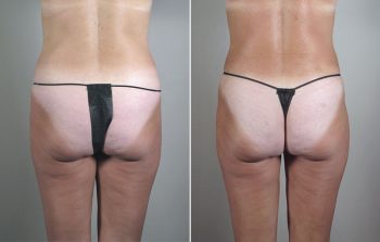 Breast Lift with Implants Patient 24