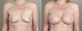 Breast Enlargement (Augmentation) Patient 60