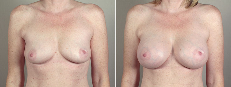 Breast Enlargement (Augmentation) Patient 60