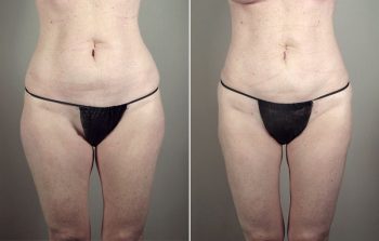 Breast Enlargement (Augmentation) Patient 60