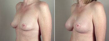 Breast Enlargement (Augmentation) Patient 60