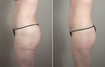 Breast Enlargement (Augmentation) Patient 60