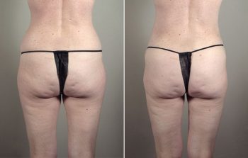 Breast Enlargement (Augmentation) Patient 60