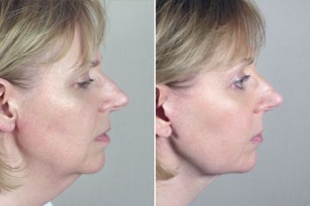 Neck Lift Patient 6