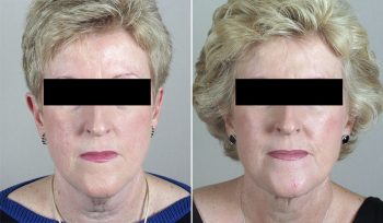 Neck Lift Patient 7