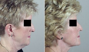 Neck Lift Patient 7
