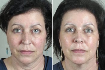Rhinoplasty Patient 45