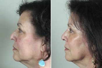 Rhinoplasty Patient 45