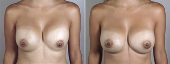 Removal & Replacement of Implants Patient 20