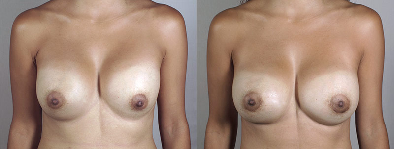 Removal & Replacement of Implants Patient 20