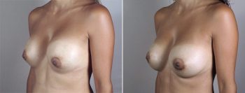 Removal & Replacement of Implants Patient 20