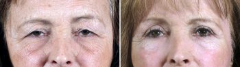 Upper Eyelid Lift Patient 19