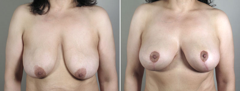 Breast Lift with Implants Patient 25