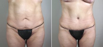 Breast Lift with Implants Patient 25