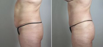 Breast Lift with Implants Patient 25