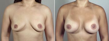 Breast Enlargement (Augmentation) Patient 61