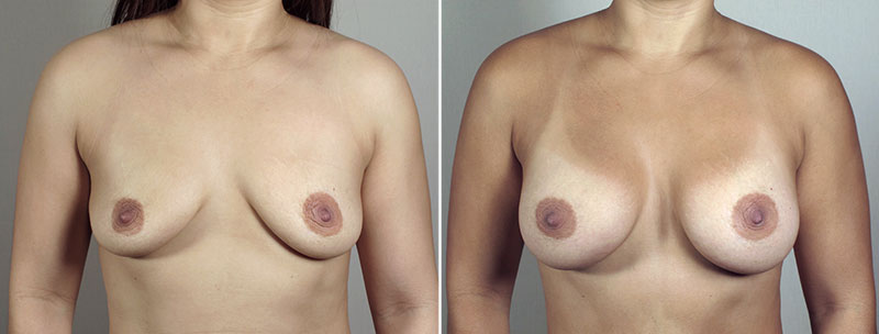 Breast Enlargement (Augmentation) Patient 61