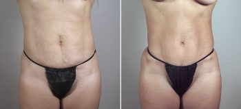 Breast Enlargement (Augmentation) Patient 61