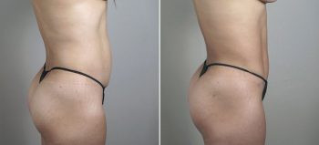 Breast Enlargement (Augmentation) Patient 61