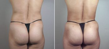 Breast Enlargement (Augmentation) Patient 61