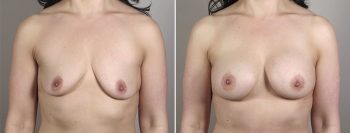 Breast Enlargement (Augmentation) Patient 62