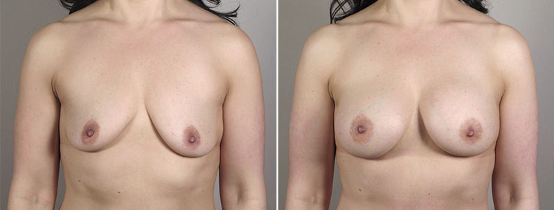 Breast Enlargement (Augmentation) Patient 62