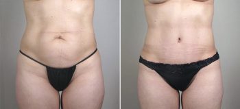 Breast Enlargement (Augmentation) Patient 62