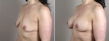 Breast Enlargement (Augmentation) Patient 62