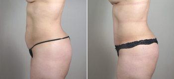 Breast Enlargement (Augmentation) Patient 62