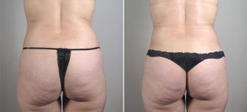 Breast Enlargement (Augmentation) Patient 62